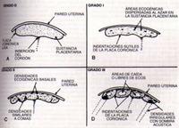 Los grados de la placenta en imágenes