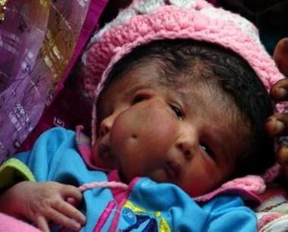 Una niña con dos caras: ¿bendición o maldición? ¿pueden negarse los padres a operarla?