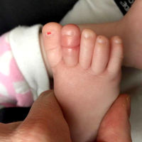 Cuidado con el síndrome del torniquete por cabellos o hilos: una niña lo sufrió y sus padres están alertando en las redes sociales