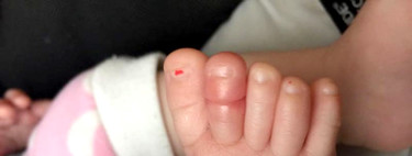 Cuidado con el síndrome del torniquete por cabellos o hilos: una niña lo sufrió y sus padres están alertando en las redes sociales