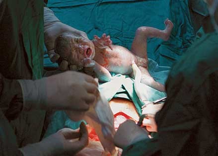 Cesáreas innecesarias en la sanidad privada