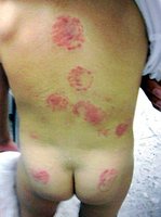 Una niña de 22 meses podría haber sufrido 30 mordiscos en la guardería