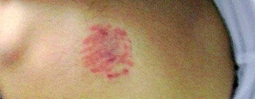 Una niña de 22 meses podría haber sufrido 30 mordiscos en la guardería