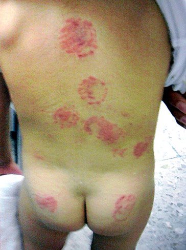 Una niña de 22 meses podría haber sufrido 30 mordiscos en la guardería