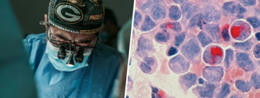En los últimos 20 años, el cáncer colorrectal se ha duplicado entre los jóvenes sin saber por qué. Ahora tenemos pista