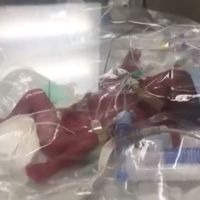 Un bebé prematuro de 23 semanas y 760 gramos logra sobrevivir gracias a mantenerlo en una bolsa de plástico con oxígeno