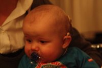 Implantes cocleares: ¿quiénes pueden beneficiarse de ellos?