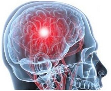 Se disparan los accidentes cerebrovasculares entre los millennials