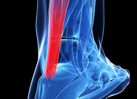 Podemos acabar con el fantasma de la tendinitis si sabemos cómo