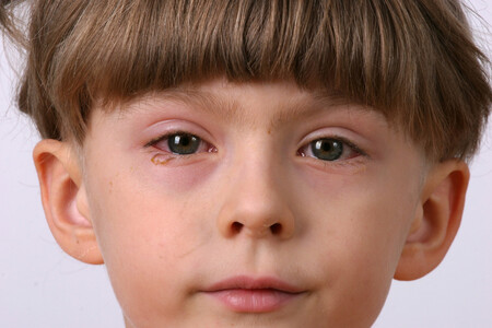 conjuntivitis