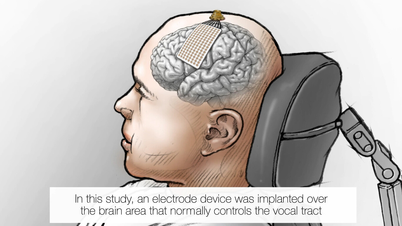 Neuroprosthesis Restores Words To Man With Paralysis 00 00 34 02 Imagen Fija002