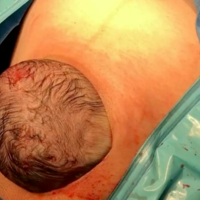 Lo más parecido a un parto vaginal: así asoma la cabeza del bebé en una 'cesárea natural' (vídeo)