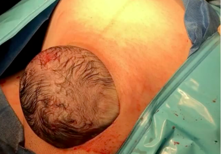 Lo más parecido a un parto vaginal: así asoma la cabeza del bebé en una 'cesárea natural' (vídeo)