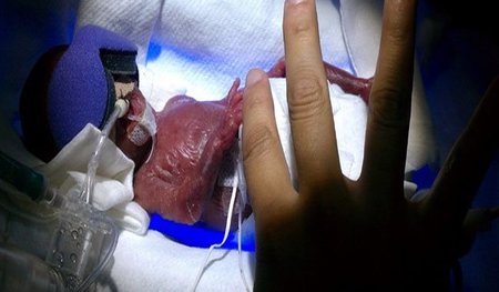 Una bebé nacida con 270 gramos ha logrado salir adelante
