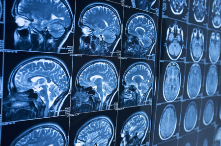 Un nuevo fármaco puede frenar el deterioro cognitivo en los pacientes de Alzheimer