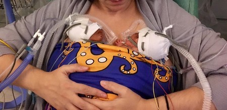 Método canguro: una enfermera crea una banda elástica para favorecer el contacto piel con piel con el bebé prematuro