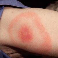Cuidado con las picaduras en verano. Cómo asegurarse que no te has infectado con la enfermedad de Lyme 