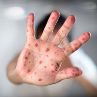 La OMS alerta de que los casos de sarampión en el mundo se han disparado hasta alcanzar cifras históricas