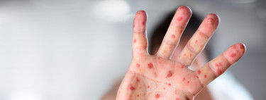 La OMS alerta de que los casos de sarampión en el mundo se han disparado hasta alcanzar cifras históricas