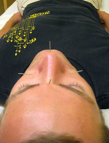 acupuntura