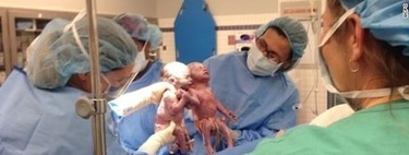 Impactante: gemelas idénticas nacen tomadas de la mano 
