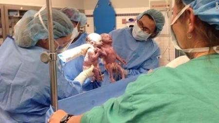 Impactante: gemelas idénticas nacen tomadas de la mano