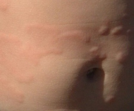 Urticaria Near Navel