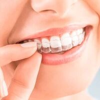 Invisalign en adolescentes: cuándo se recomienda y qué debes saber si tu hijo va a comenzar un tratamiento de ortodoncia invisible 