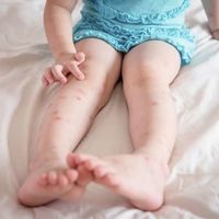 Alergia a las picaduras de insectos en niños: cuáles son los síntomas de gravedad y qué debemos hacer