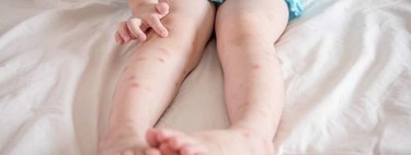 Alergia a las picaduras de insectos en niños: cuáles son los síntomas de gravedad y qué debemos hacer