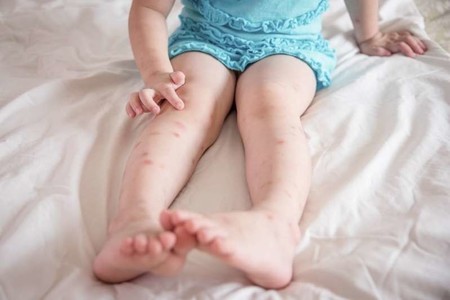 Alergia a las picaduras de insectos en niños: cuáles son los síntomas de gravedad y qué debemos hacer