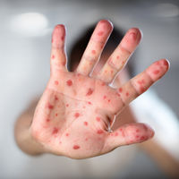 La OMS alerta del aumento de casos de sarampión a nivel mundial debido a una caída en la vacunación