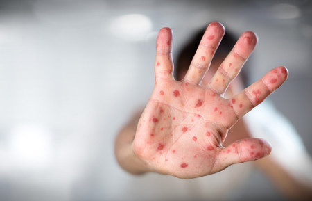 La OMS alerta del aumento de casos de sarampión a nivel mundial debido a una caída en la vacunación