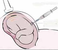 Cómo se hace una amniocentesis, en imágenes  