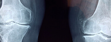 Novo biomaterial consegue fazer o que antes só se via na ficção científica: crescer cartilagem articular de grande qualidade 