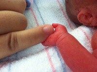 La retinopatía del prematuro 