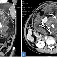 Extirpan a una adolescente el feto malformado de su gemelo: un extraño caso de "fetus in fetu"