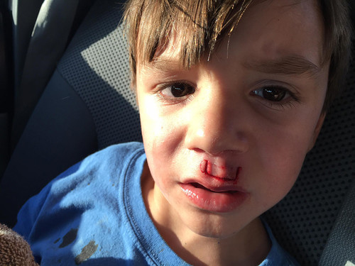 Un padre advierte sobre el uso de los spinners después de que su hijo terminara en urgencias