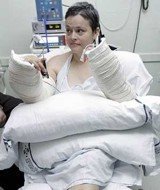 Primer transplante bilateral de manos