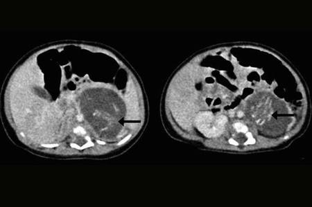 Baby Born With Two Foetuses In Stomach 1