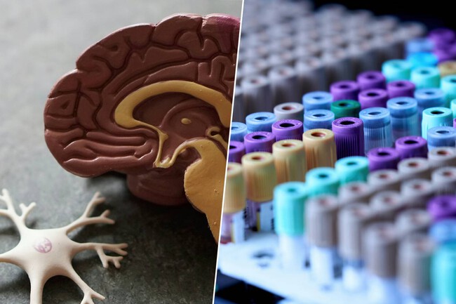 Alzheimer Analisis