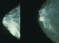 Lugares a los que no deberías ir si quieres conservar una buena salud (I): cáncer