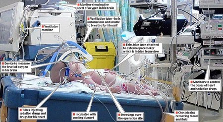 Terapia de frío para salvar la vida de un bebé