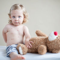 Brote de sarampión en Barcelona: ¿por qué es importante completar la vacunación de nuestros hijos?