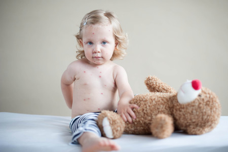 Brote de sarampión en Barcelona: ¿por qué es importante completar la vacunación de nuestros hijos?