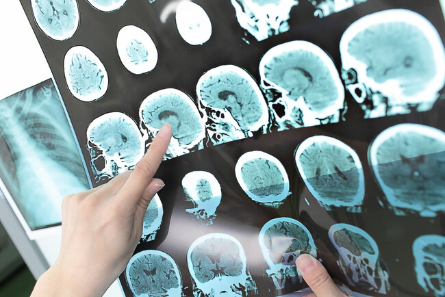 Cerebro