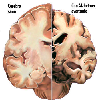 Un nuevo componente de la naturaleza podría colaborar con el Alzheimer