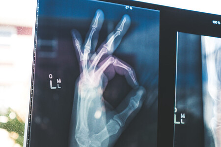 Radiografía de una mano haciendo un signo de ok