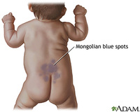 Mi hijo tiene una mancha en la espalda y las nalgas: la mancha mongólica