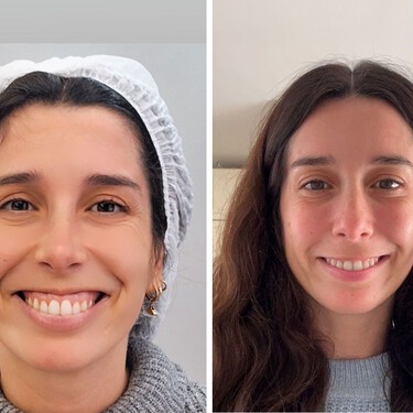 He probado el bótox para mejorar la sonrisa gingival y lo único de lo que me arrepiento es de no haberlo hecho antes 